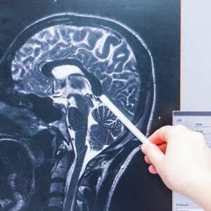 traumatic brain injury-diagnosis-accident