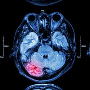 brain injuries from a car accident