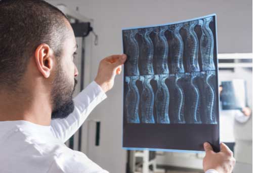 A doctor looking at an x-ray of a spinal cord injury