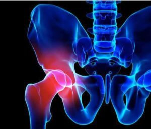 hip injury from a car accident shown on a skeleton