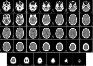 Long Term Traumatic Brain Injury Effects
