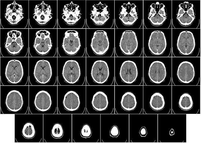 Long Term Traumatic Brain Injury Effects