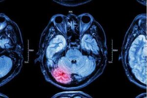 Brain scan of severe injury