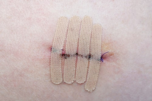 cuts & lacerations