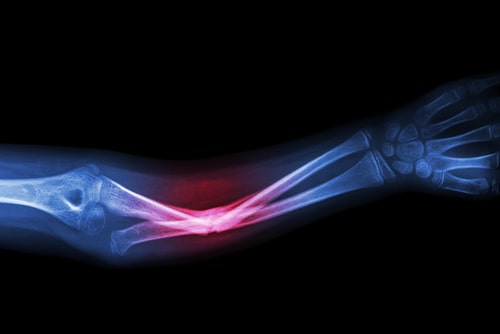 Broken Bones