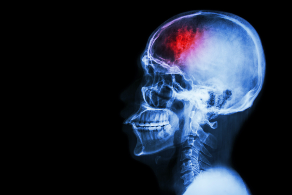 Traumatic brain injuries can result from various accidents