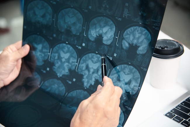 traumatic brain injury litigation through a traumatic brain injury lawyer